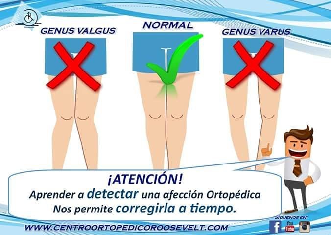 Comparación entre genu valgus, rodilla normal y genu varus