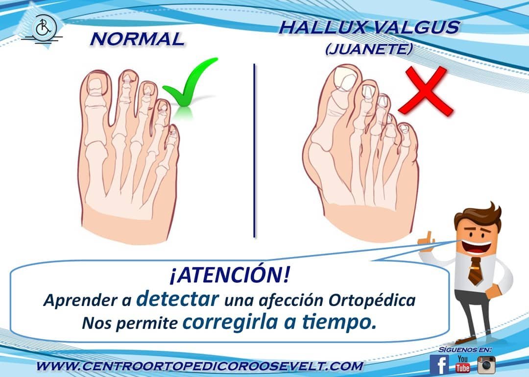 Comparación entre pie normal y hallux valgus o juanete