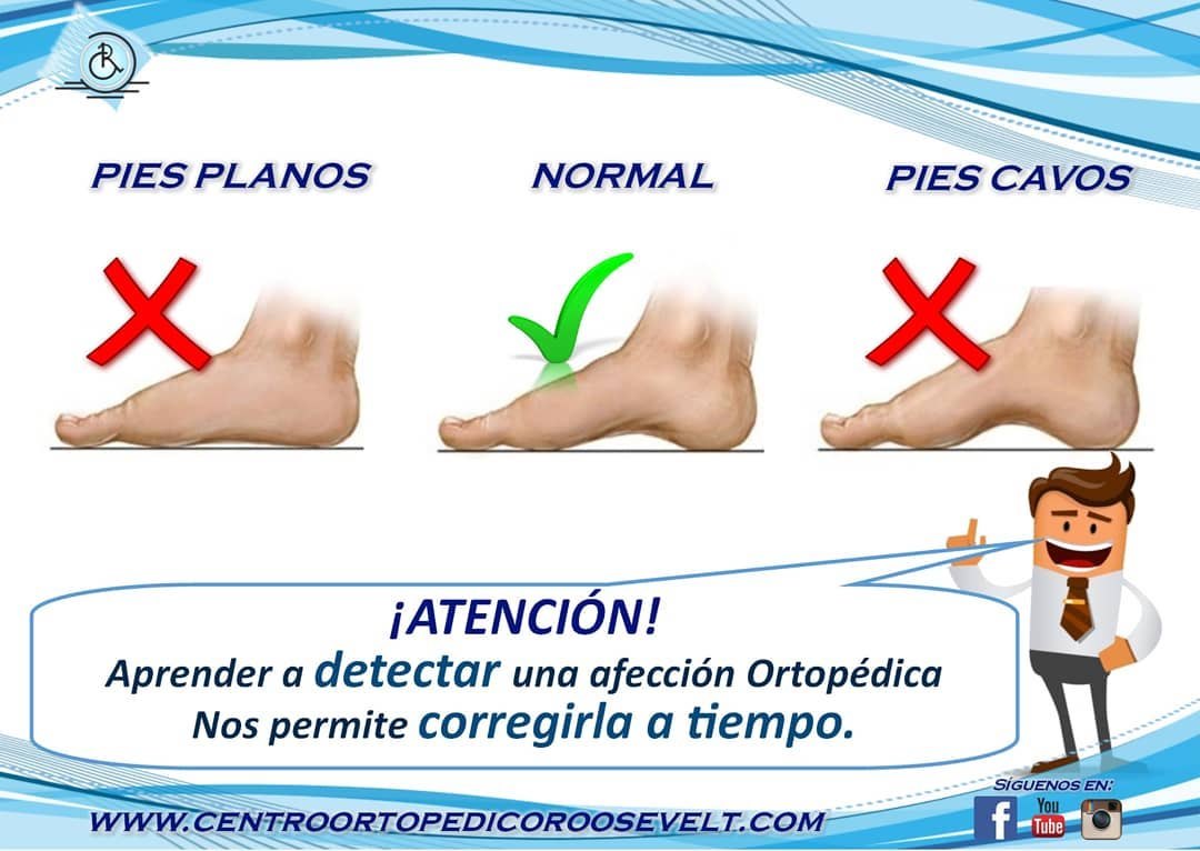 Comparación entre pies planos, pie normal y pies cavos