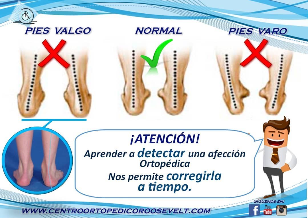 Comparación entre pies valgo, normal y varo