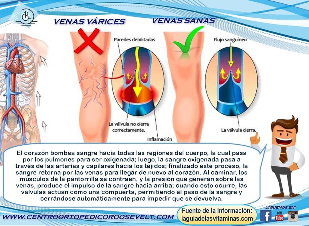 Infografía comparando venas várices con venas sanas y el retorno venoso
